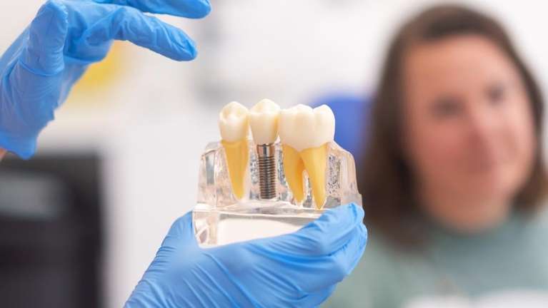 BENEFITS OF DENTAL IMPLANTS